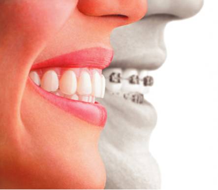 Invisalign